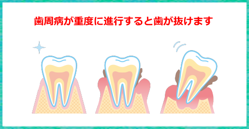 歯周病治療と予防方法